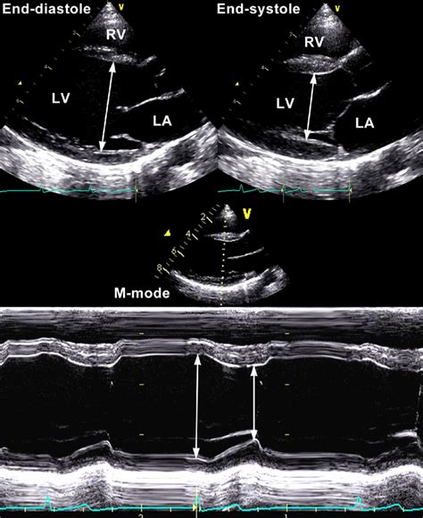 lv end diastolic dimension.